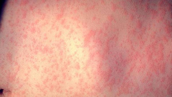 Measles case reported in Miami County, shoppers exposed at busy Kroger  