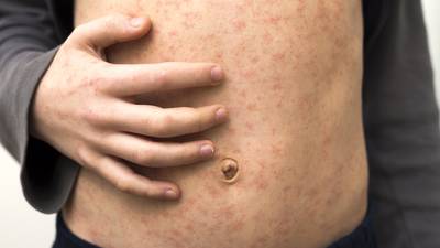 New confirmed measles case reported in Butler County