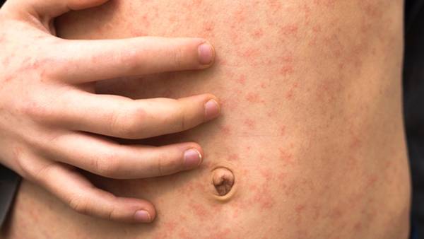 Florida county sees outbreak of measles at elementary school