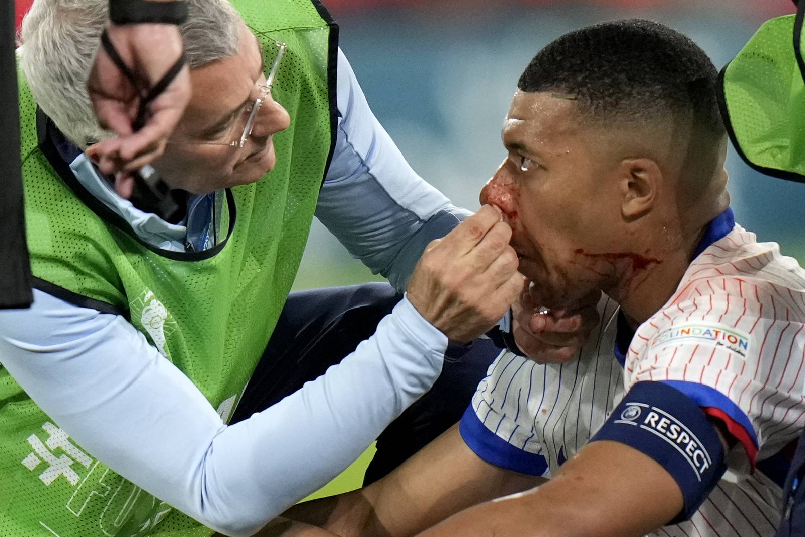 Mbappé suffers facial injury in France's 10 win against Austria at