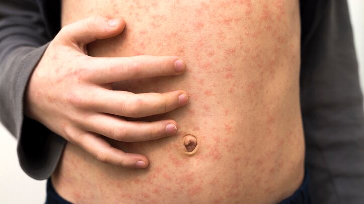 Measles causes a red rash, high fever and other symptoms.